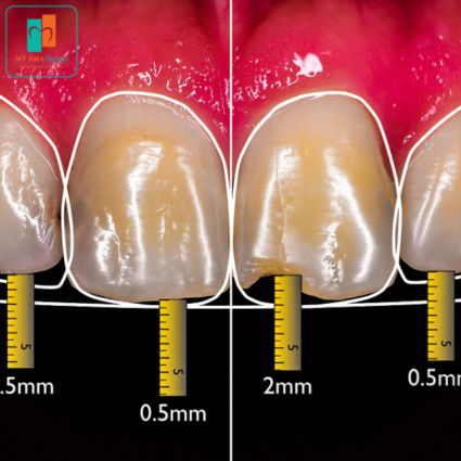 bước design smile trong quy trình bọc răng sứ