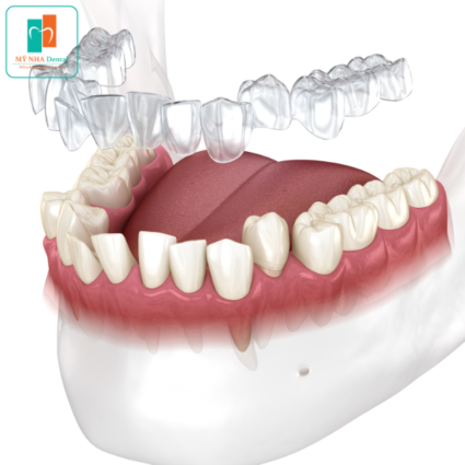 niềng răng trong suốt Invisalign