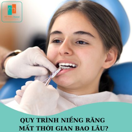 quy trình niềng răng mất thời gian bao lâu