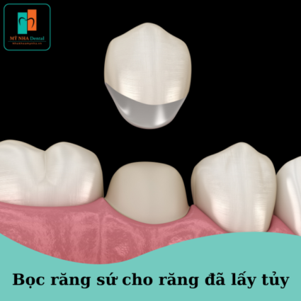 bọc răng sứ sau khi lấy tủy