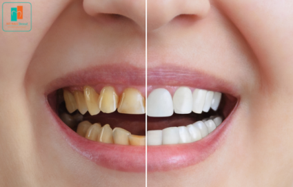 trước và sau khi bọc răng sứ Zirconia